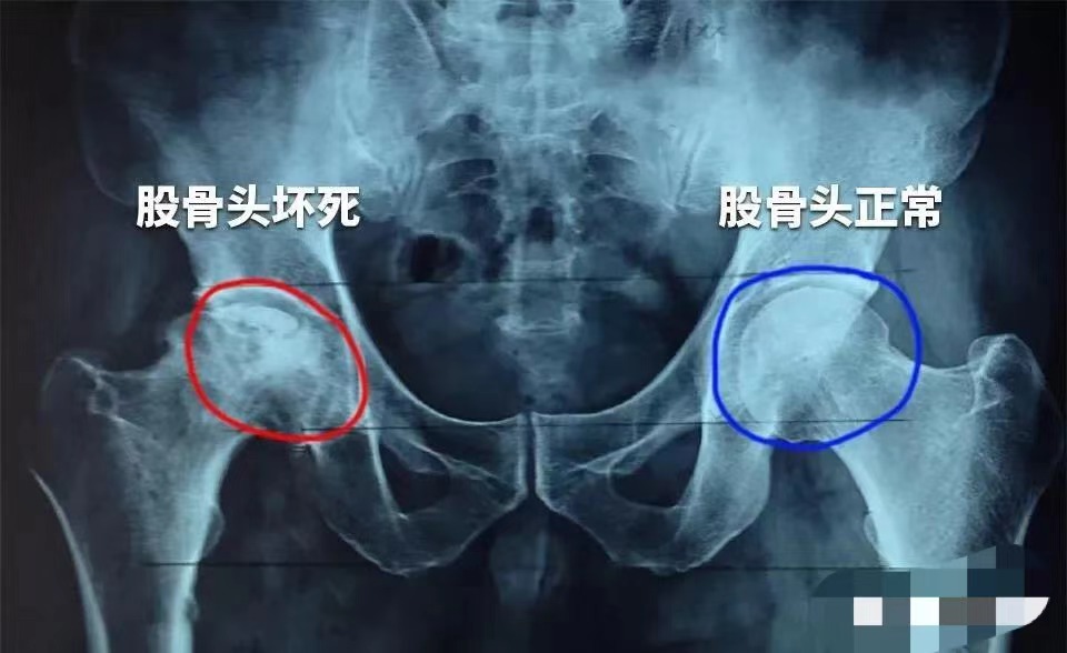 65例患者随访7.5年：干细胞治疗股骨头坏死疗效确切
